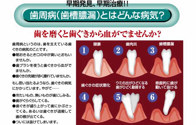 歯周病(歯槽膿漏)とはどんな病気？