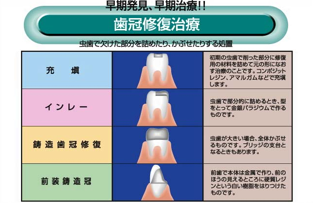 歯冠修復 │ 診療のご案内 │ しんとうデンタルクリニック