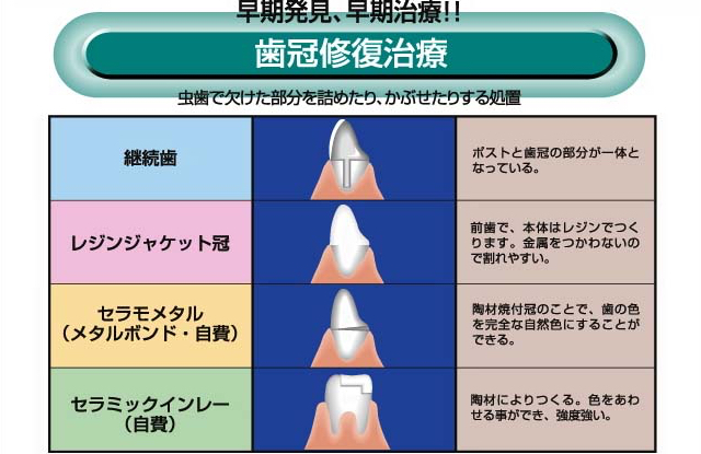 歯冠修復 │ 診療のご案内 │ しんとうデンタルクリニック