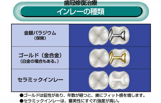 インレーの種類