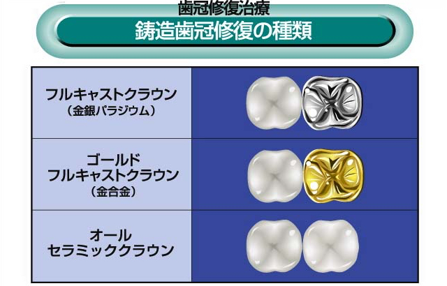 鋳造歯冠修復の種類