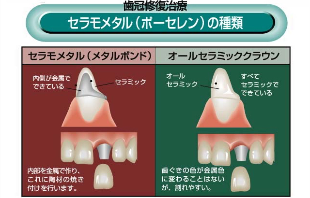 歯冠修復 │ 診療のご案内 │ しんとうデンタルクリニック