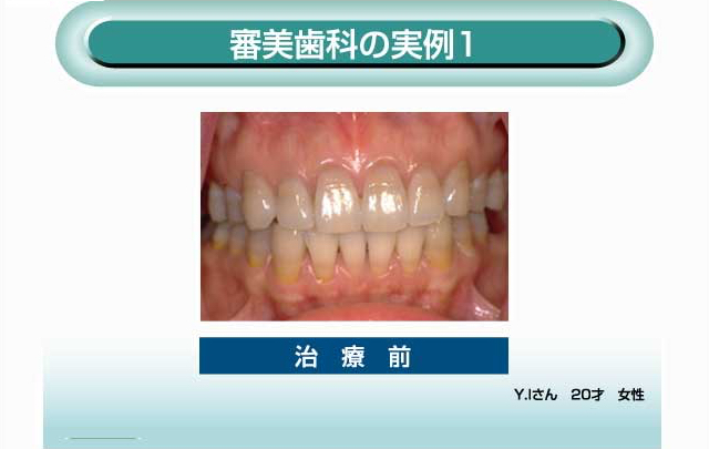 審美歯科の実例1 治療前