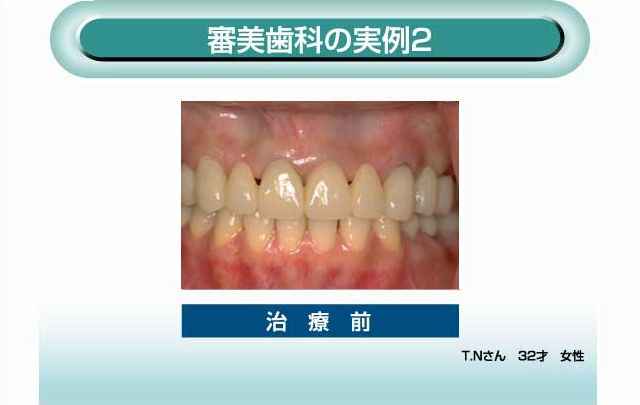 審美歯科の実例2 治療前