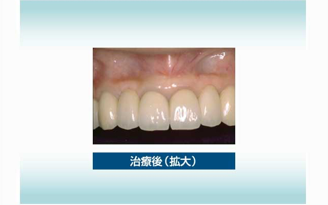 審美歯科の実例2 治療後(拡大)
