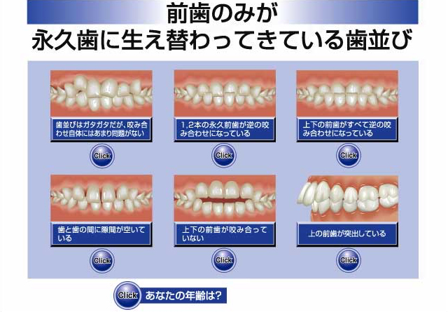 前歯のみが永久歯に生え替わってきている歯並び