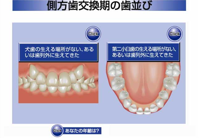 側方歯交換期の歯並び